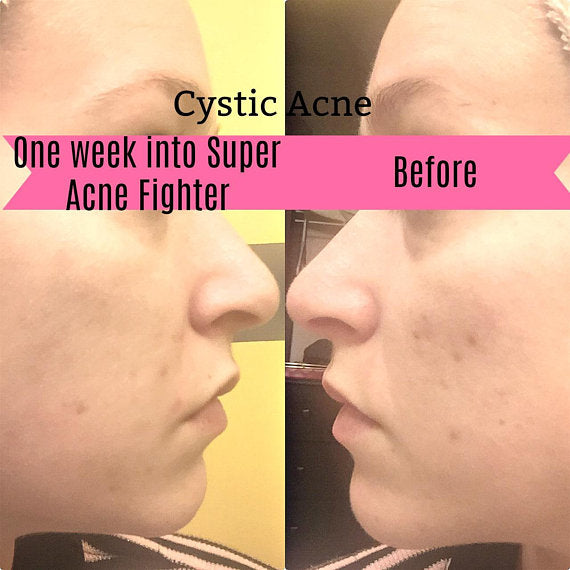 Super Acne Fighter / Organic Acne Treatment / Acne-Everyone's Marketplace